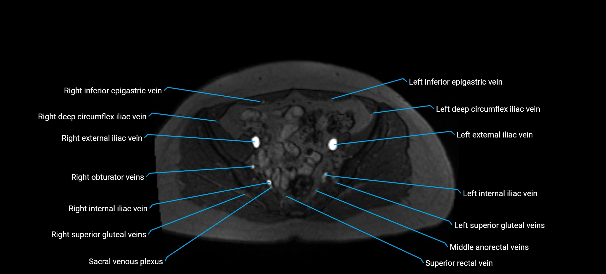 MRV abdomen pelvis & lower limb axial cross sectional anatomy labelled MRI image 150 (1).webp